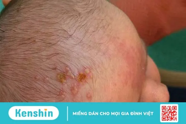 Muôn vàn câu hỏi về bệnh chốc lở da đầu ở trẻ em