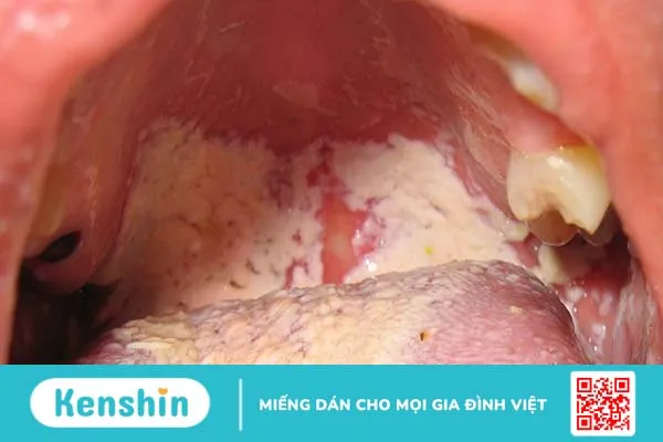 Nấm khoang miệng là bệnh gì?