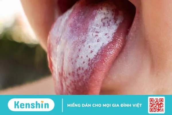 Nấm lưỡi ở trẻ 3 tuổi và một số cách điều trị hiệu quả