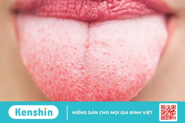 Nấm miệng bị đỏ thường gặp ở những đối tượng nào?