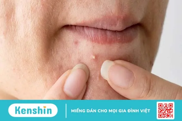 Nặn mụn xong bị lên mụn đầu trắng có sao không?