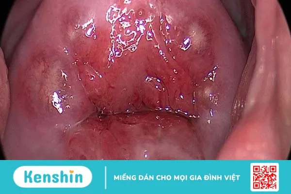 Nang naboth cổ tử cung 5mm có nguy hiểm không?