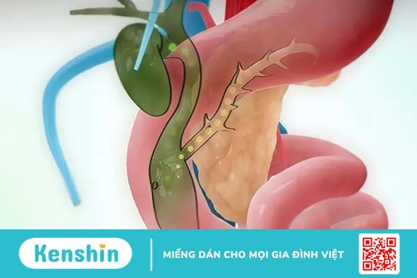 Nang ống mật chủ là gì? Phương pháp điều trị nang ống mật chủ