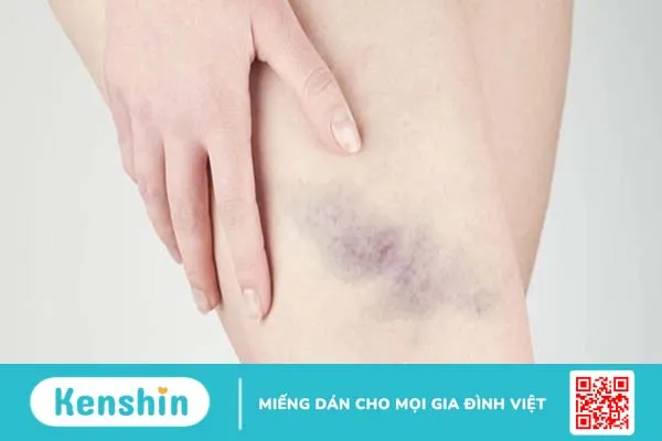 Ngứa gãi bị bầm tím và những điều cần biết