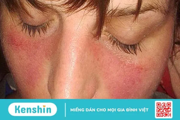 Người bệnh lupus ban đỏ ăn thịt bò được không?