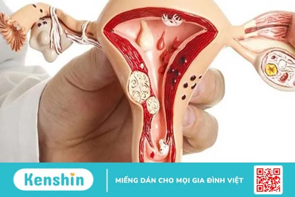 Người bệnh u xơ tử cung có nên ăn đậu phụ không?