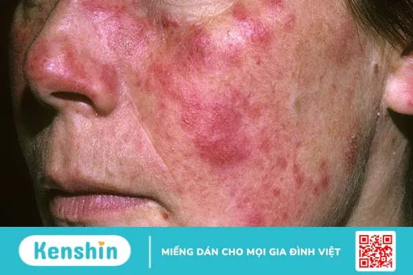 Người bị bệnh lupus ban đỏ nên kiêng ăn gì?