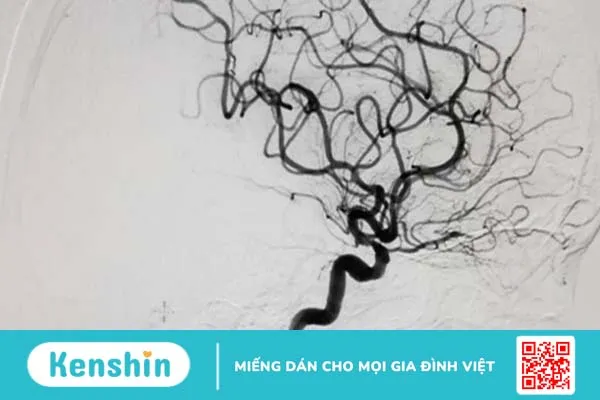 Nguyên lý chụp mạch số hóa xóa nền DSA