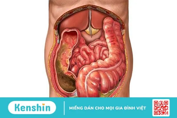 Nguyên nhân gây bệnh u sau phúc mạc