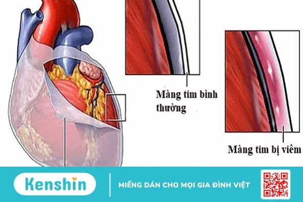 Nguyên nhân gây bệnh viêm màng ngoài tim co thắt