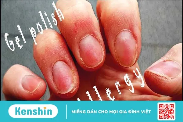 Nguyên nhân gây dị ứng sơn gel là gì? Cách xử trí như thế nào?