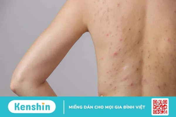 Nguyên nhân gây mụn nhọt ở lưng và cách điều trị