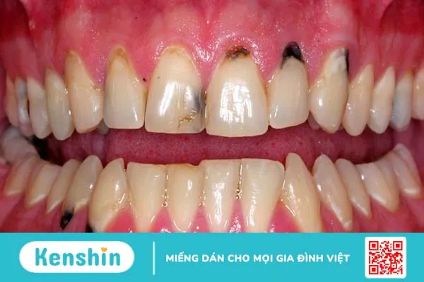 Nguyên nhân khiến chân răng đen và cách khắc phục hiệu quả