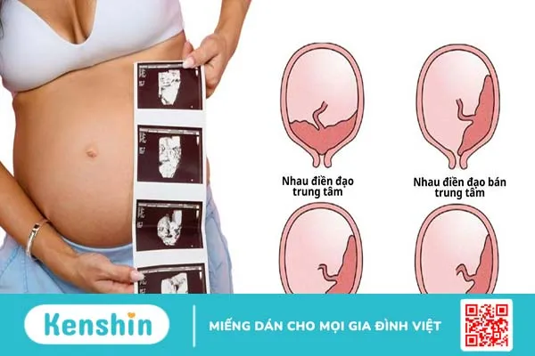 Nguyên nhân mang thai 20 tuần bị ra máu và cách xử trí