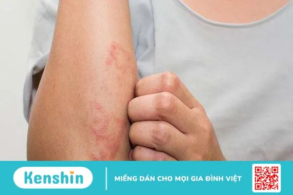 Nguyên nhân và dấu hiệu bị dị ứng nước giặt quần áo