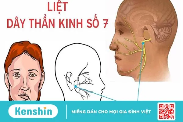 Nguyên nhân và dấu hiệu liệt dây thần kinh số 7 ở trẻ em