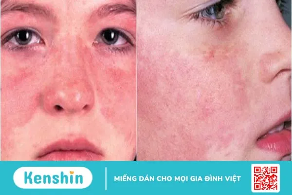 Nhận biết lupus ban đỏ ở phụ nữ và phương pháp điều trị