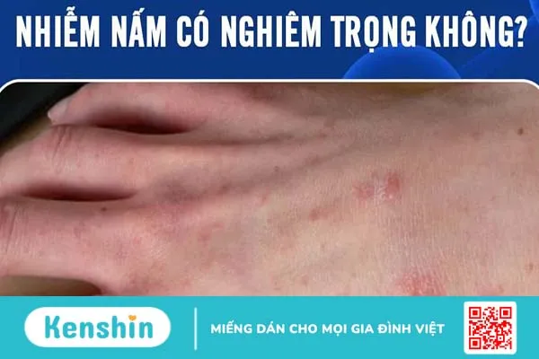 Nhiễm nấm có nghiêm trọng không?