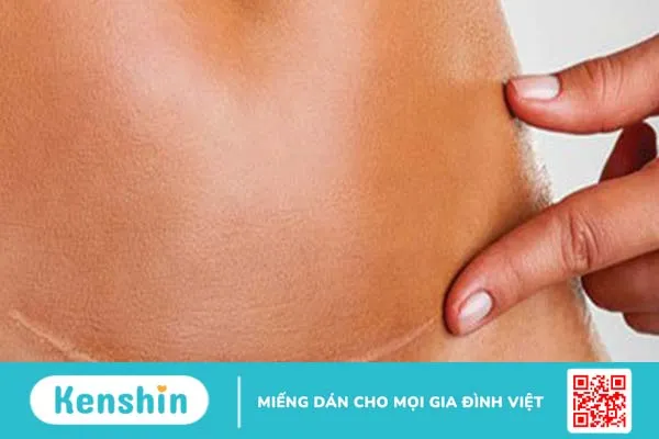 Nhiễm trùng vết mổ: Cần được nhận biết sớm để xử lý kịp thời