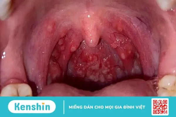 Nhiệt miệng trong cổ họng: Nguyên nhân, triệu chứng và cách xử trí