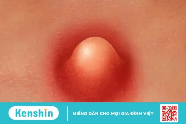 Nhọt ống tai ngoài ở trẻ sơ sinh: Bố mẹ không nên xem thường