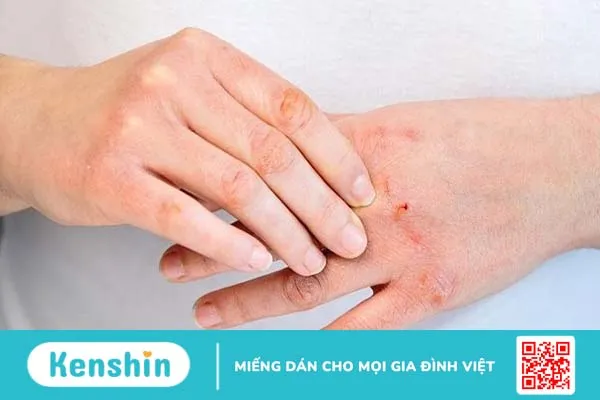 Những ai có thể bị nhiễm nấm?