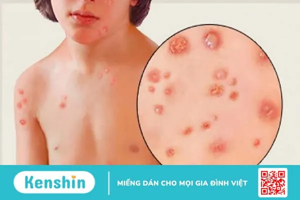 Những cách chữa thủy đậu dân gian an toàn, hiệu quả