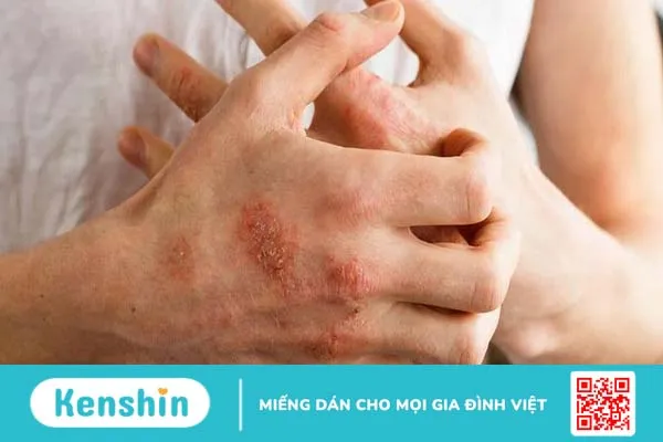 Những cách xử lí khi dị ứng bao cao su vô cùng hiệu quả