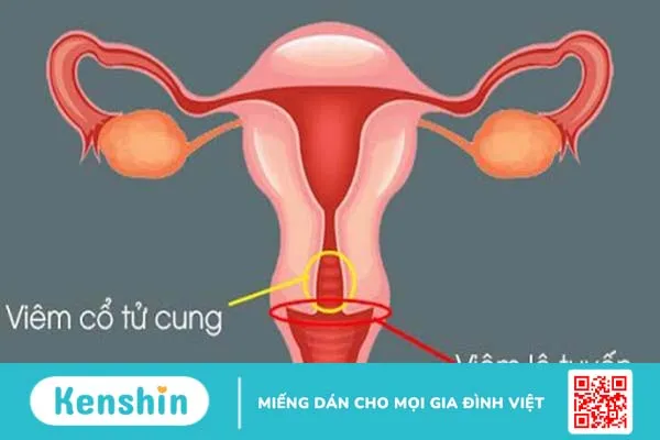 Những chia sẻ về viêm lộ tuyến tử cung độ 3