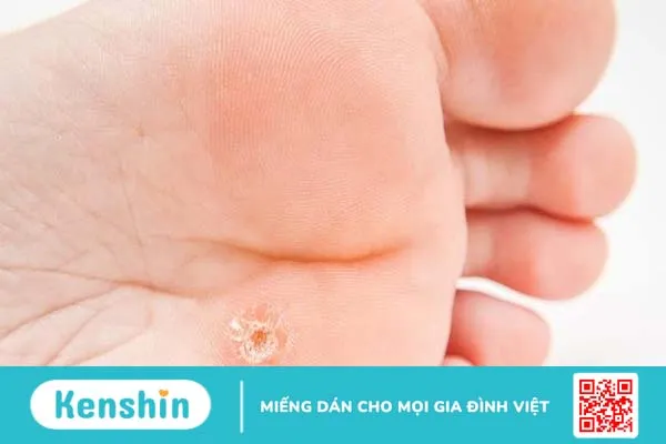 Những dấu hiệu và triệu chứng mụn cóc lòng bàn chân