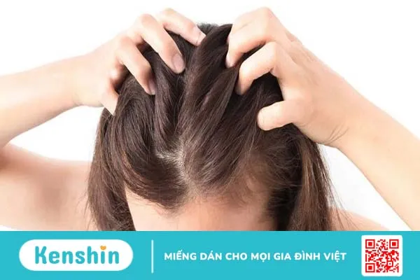 Những điều cần biết khi điều trị nấm tổ ong da đầu