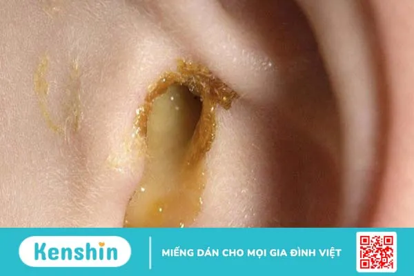 Những điều cần biết về bệnh lý tai chảy mủ