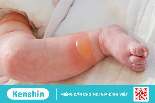 Những điều cần biết về chốc lở dạng phỏng