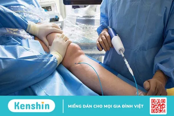 Những điều cần biết về keo sinh học tĩnh mạch và bệnh suy giãn tĩnh mạch chi dưới