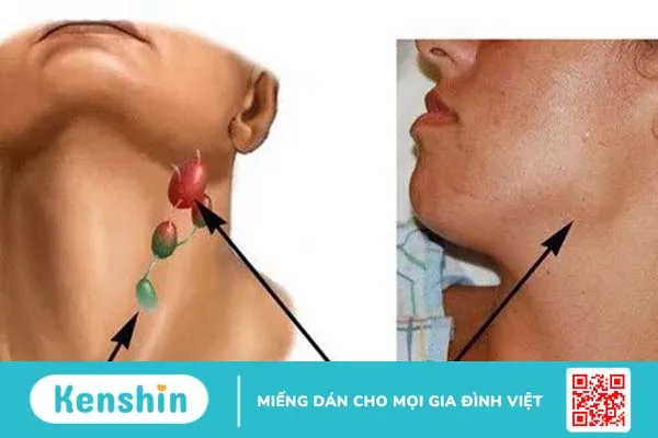 Những điều cần biết về sinh thiết hạch