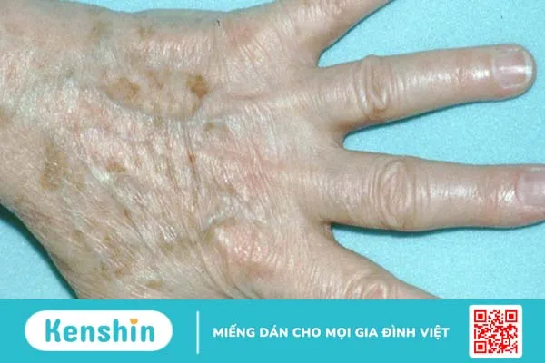 Những loại kem trị đồi mồi ở tay của Nhật hiệu quả nhất hiện nay