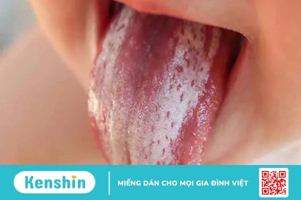 Những thông tin cần biết về căn bệnh nấm miệng dưới lưỡi ở trẻ em