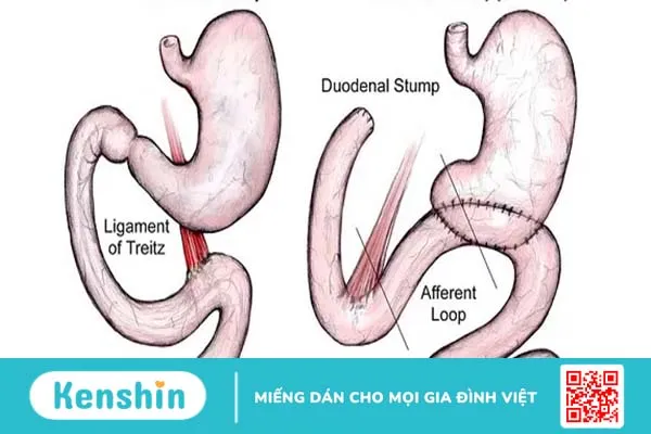 Nối dạ dày hỗng tràng là gì? Phương pháp nối và những lưu ý sau điều trị