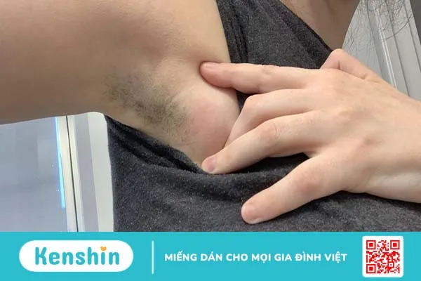 Nổi hạch ở nách có mủ nguy hiểm không? Điều trị hiện tượng nổi hạch ở nách như thế nào?