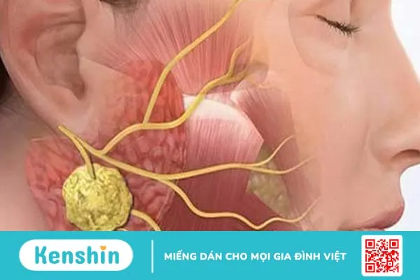 Nổi hạch tuyến mang tai là biểu hiện của bệnh gì và cách phòng tránh ra sao?