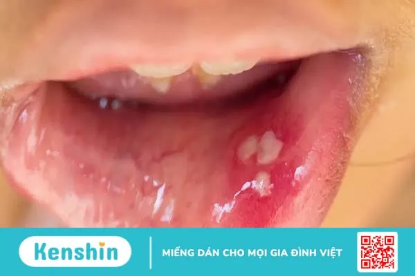 Nổi mụn trắng trong miệng không đau là dấu hiệu bệnh gì?