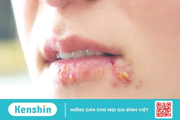 Phác đồ điều trị Herpes môi giúp kiểm soát các triệu chứng