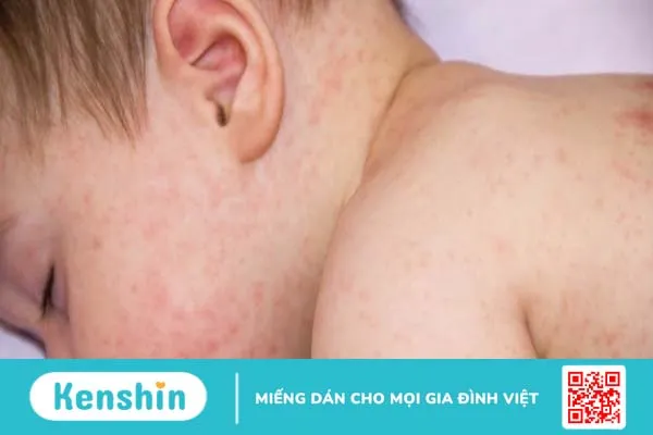 Phác đồ tiếp cận lupus ban đỏ hệ thống ở người trẻ mà bạn nên biết