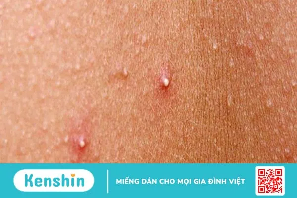 Phải làm sao khi mông bị nổi mụn đỏ?