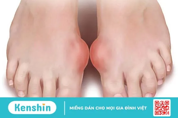 Phân biệt bệnh gout và giả gout: Nguyên nhân, chẩn đoán và cách điều trị