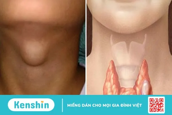 Phân biệt bướu cổ và u tuyến giáp. Nguyên nhân và cách điều trị