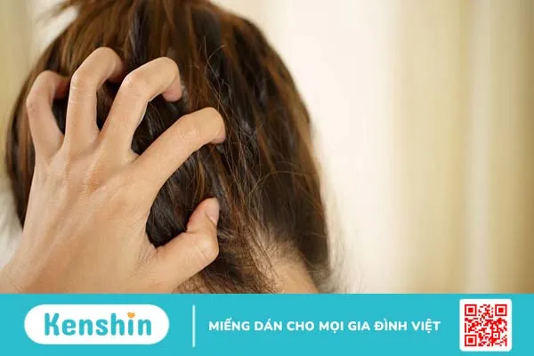 Phân biệt dấu hiệu của bị gàu và bệnh vẩy nến da đầu