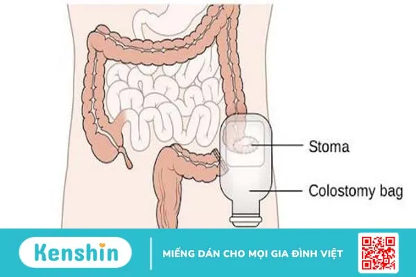 Phẫu thuật làm hậu môn nhân tạo