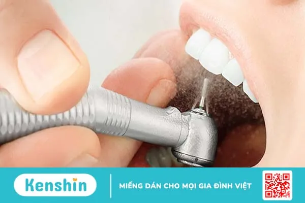 Phương pháp cạo vôi răng siêu âm