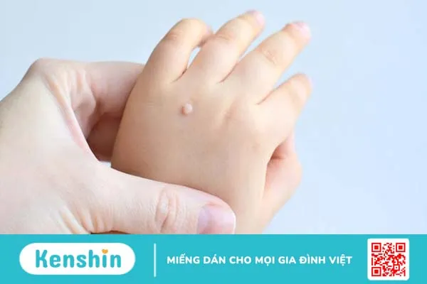 Phương pháp trị mụn cóc ở trẻ em an toàn, hiệu quả